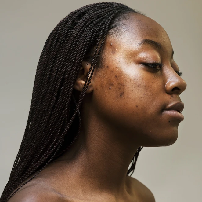 Hyperpigmentation