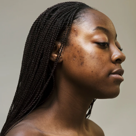 Hyperpigmentation